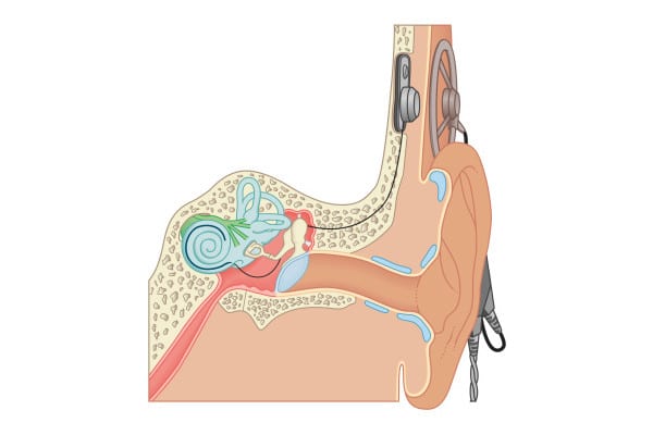 Cochlear-Implant